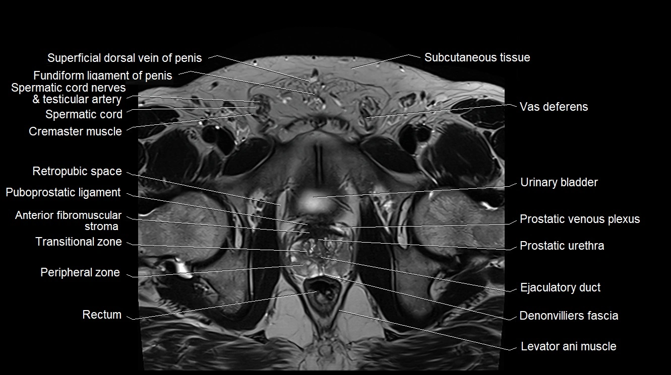 MRI 3T scrotum and penis axial cross sectional anatomy image 8.webp